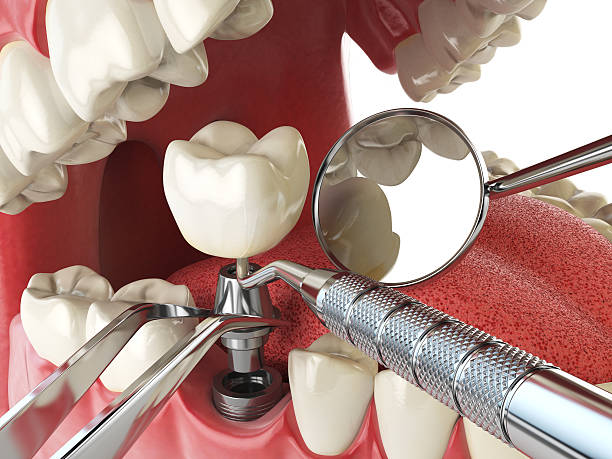 Best Emergency Wisdom Teeth Removal in Marion Oaks, FL